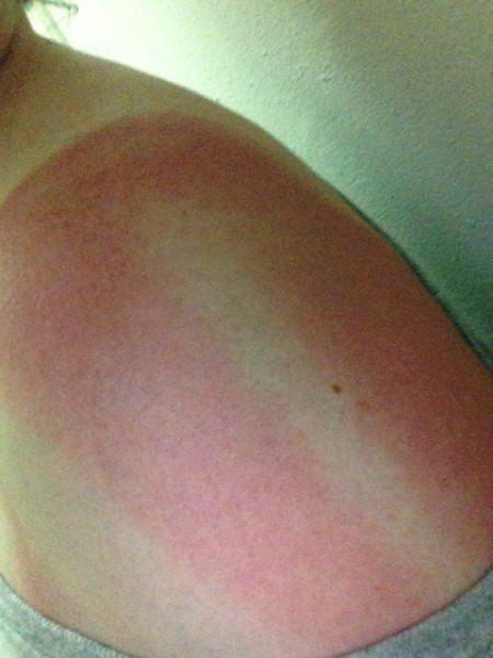 left shoulder sunburn